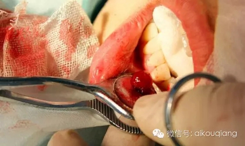 粘液腺囊腫 粘液腺囊腫