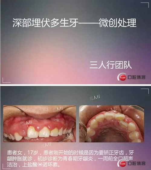 深部埋伏多生牙——微創(chuàng)處理 深部埋伏多生牙——微創(chuàng)處理