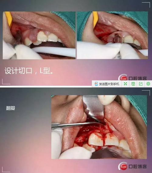 深部埋伏多生牙——微創(chuàng)處理 深部埋伏多生牙——微創(chuàng)處理