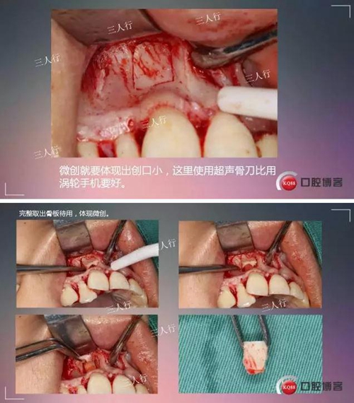 深部埋伏多生牙——微創(chuàng)處理 深部埋伏多生牙——微創(chuàng)處理