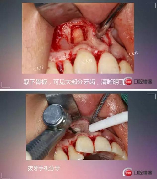 深部埋伏多生牙——微創(chuàng)處理 深部埋伏多生牙——微創(chuàng)處理