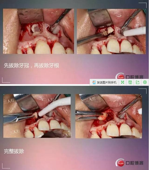 深部埋伏多生牙——微創(chuàng)處理 深部埋伏多生牙——微創(chuàng)處理