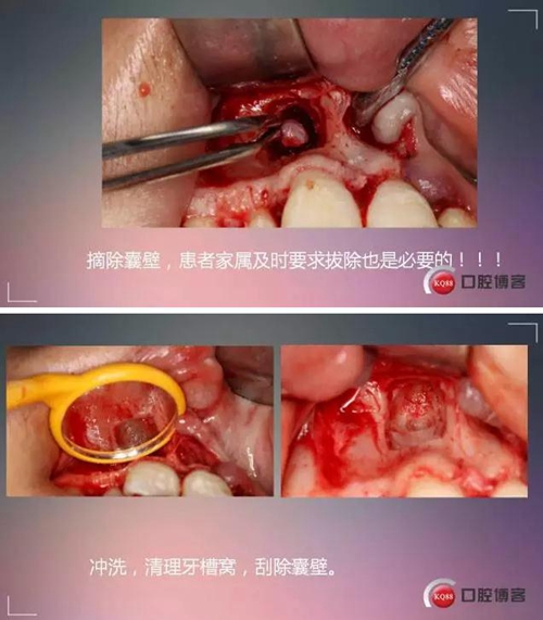 深部埋伏多生牙——微創(chuàng)處理 深部埋伏多生牙——微創(chuàng)處理