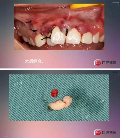 深部埋伏多生牙——微創(chuàng)處理 深部埋伏多生牙——微創(chuàng)處理