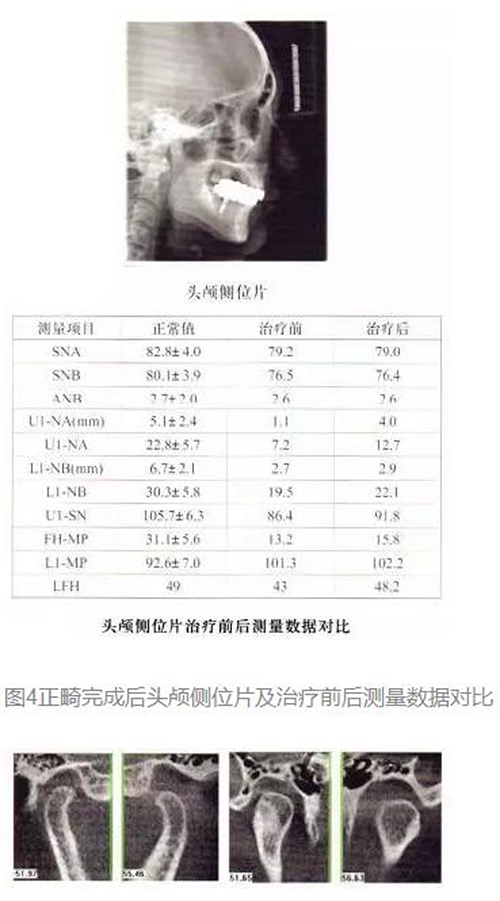 正畸修復聯(lián)合咬合重建1例 正畸修復聯(lián)合咬合重建1例