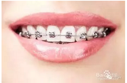 正畸流程(拔牙) 正畸流程(拔牙)