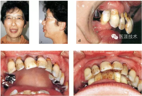 全口拔牙即戴全口活動(dòng)義齒修復(fù)病例 全口拔牙即戴全口活動(dòng)義齒修復(fù)病例