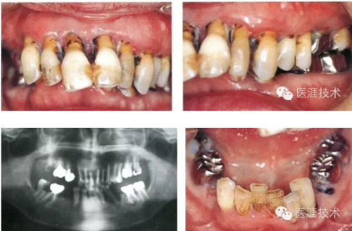 全口拔牙即戴全口活動(dòng)義齒修復(fù)病例 全口拔牙即戴全口活動(dòng)義齒修復(fù)病例