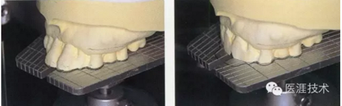 全口拔牙即戴全口活動(dòng)義齒修復(fù)病例 全口拔牙即戴全口活動(dòng)義齒修復(fù)病例