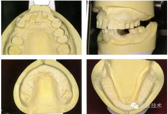全口拔牙即戴全口活動(dòng)義齒修復(fù)病例 全口拔牙即戴全口活動(dòng)義齒修復(fù)病例