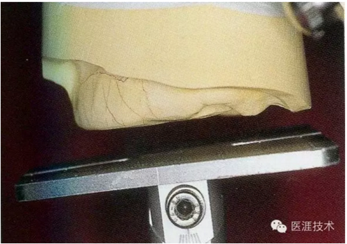 全口拔牙即戴全口活動(dòng)義齒修復(fù)病例 全口拔牙即戴全口活動(dòng)義齒修復(fù)病例