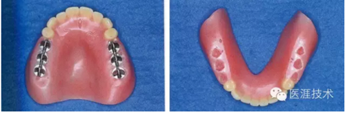 全口拔牙即戴全口活動(dòng)義齒修復(fù)病例 全口拔牙即戴全口活動(dòng)義齒修復(fù)病例