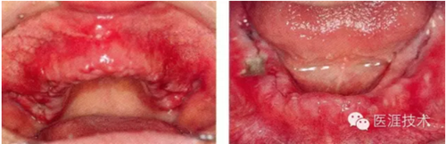 全口拔牙即戴全口活動(dòng)義齒修復(fù)病例 全口拔牙即戴全口活動(dòng)義齒修復(fù)病例