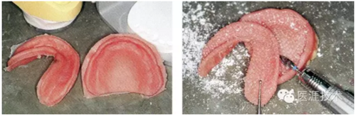 全口拔牙即戴全口活動(dòng)義齒修復(fù)病例 全口拔牙即戴全口活動(dòng)義齒修復(fù)病例