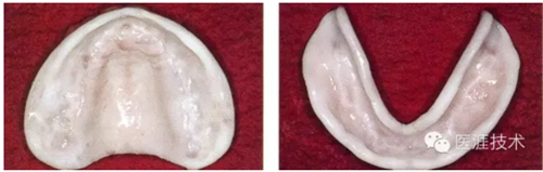 全口拔牙即戴全口活動(dòng)義齒修復(fù)病例 全口拔牙即戴全口活動(dòng)義齒修復(fù)病例