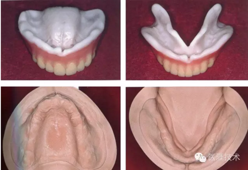 全口拔牙即戴全口活動(dòng)義齒修復(fù)病例 全口拔牙即戴全口活動(dòng)義齒修復(fù)病例