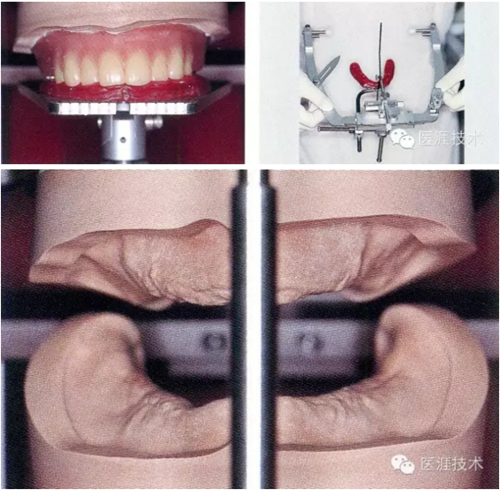 全口拔牙即戴全口活動(dòng)義齒修復(fù)病例 全口拔牙即戴全口活動(dòng)義齒修復(fù)病例