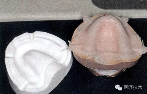 全口拔牙即戴全口活動(dòng)義齒修復(fù)病例 全口拔牙即戴全口活動(dòng)義齒修復(fù)病例