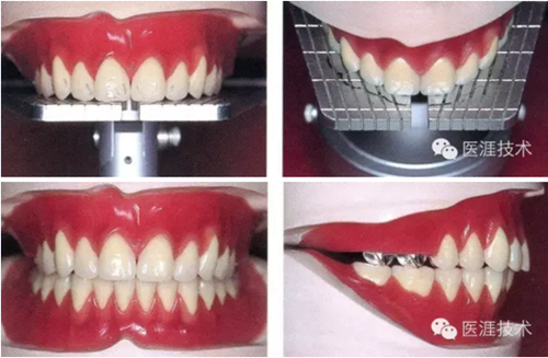 全口拔牙即戴全口活動(dòng)義齒修復(fù)病例 全口拔牙即戴全口活動(dòng)義齒修復(fù)病例