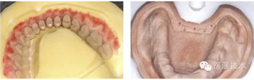 全口拔牙即戴全口活動(dòng)義齒修復(fù)病例 全口拔牙即戴全口活動(dòng)義齒修復(fù)病例
