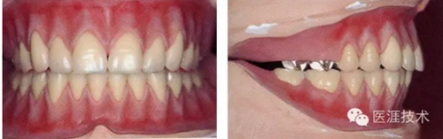 全口拔牙即戴全口活動(dòng)義齒修復(fù)病例 全口拔牙即戴全口活動(dòng)義齒修復(fù)病例