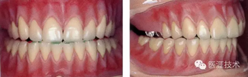 全口拔牙即戴全口活動(dòng)義齒修復(fù)病例 全口拔牙即戴全口活動(dòng)義齒修復(fù)病例