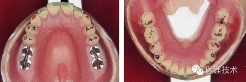 全口拔牙即戴全口活動(dòng)義齒修復(fù)病例 全口拔牙即戴全口活動(dòng)義齒修復(fù)病例
