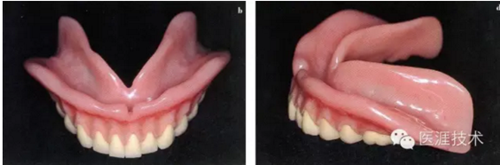 全口拔牙即戴全口活動(dòng)義齒修復(fù)病例 全口拔牙即戴全口活動(dòng)義齒修復(fù)病例