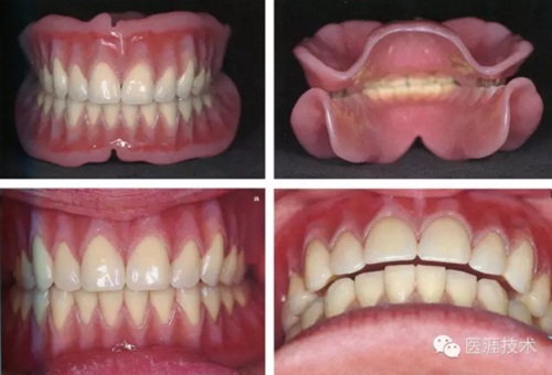 全口拔牙即戴全口活動(dòng)義齒修復(fù)病例 全口拔牙即戴全口活動(dòng)義齒修復(fù)病例