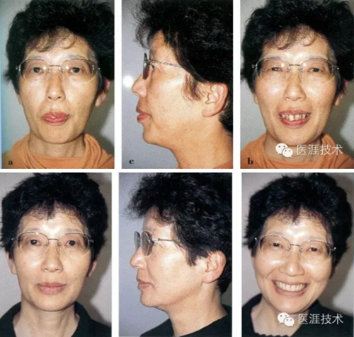 全口拔牙即戴全口活動(dòng)義齒修復(fù)病例 全口拔牙即戴全口活動(dòng)義齒修復(fù)病例