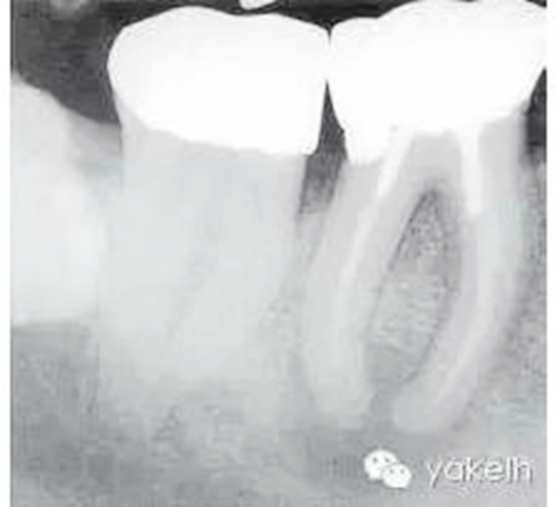 根管治療后根尖周炎(繼發(fā)感染) 科貿(mào)嘉友收錄 根管治療后根尖周炎(繼發(fā)感染) 科貿(mào)嘉友收錄