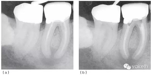 根管治療后根尖周炎(繼發(fā)感染) 根管治療后根尖周炎(繼發(fā)感染)