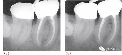 根管治療后根尖周炎(繼發(fā)感染) 根管治療后根尖周炎(繼發(fā)感染)