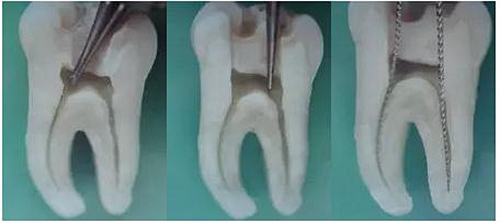根管治療圖譜 根管治療圖譜