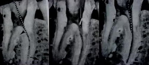 根管治療圖譜 根管治療圖譜