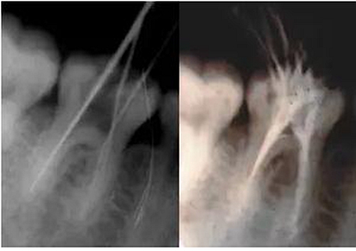 根管治療圖譜 根管治療圖譜