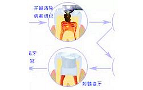 根管治療圖譜 根管治療圖譜