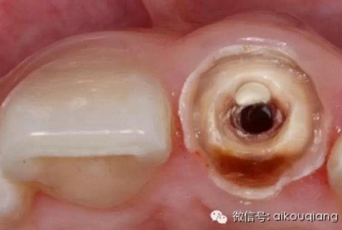 根管側(cè)穿修補(bǔ)術(shù) 根管側(cè)穿修補(bǔ)術(shù)