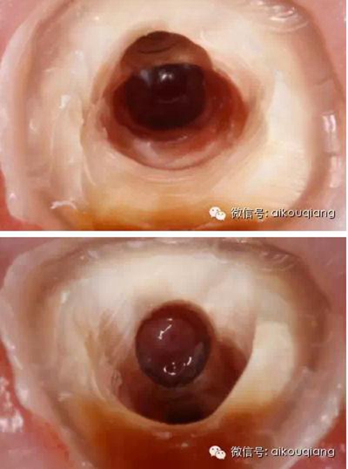 根管側(cè)穿修補(bǔ)術(shù) 根管側(cè)穿修補(bǔ)術(shù)