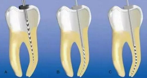 彎曲根管預(yù)備的方法和技巧 彎曲根管預(yù)備的方法和技巧