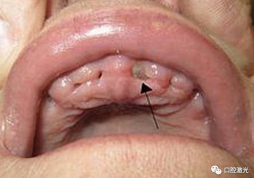 口腔激光在干槽癥中的應(yīng)用 口腔激光在干槽癥中的應(yīng)用