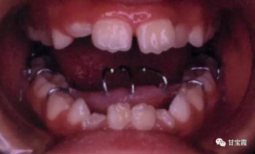 口腔不良習(xí)慣會(huì)引起牙頜畸形 口腔不良習(xí)慣會(huì)引起牙頜畸形