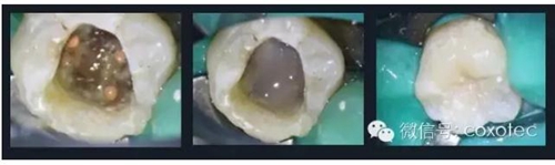 熱牙膠根管填充常見問題解答 熱牙膠根管填充常見問題解答