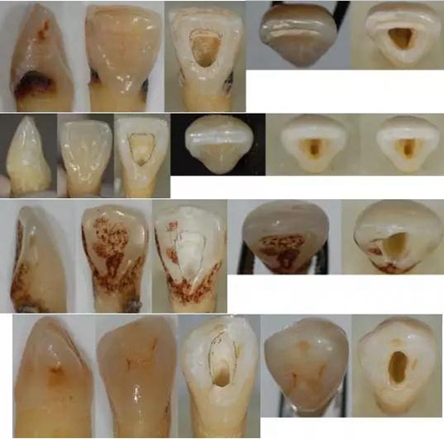 各牙齒的大概的開髓形態(tài) 各牙齒的大概的開髓形態(tài)