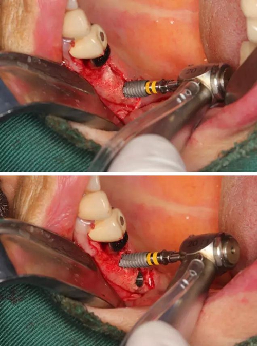 牙周病患者的外提升 牙周病患者的外提升