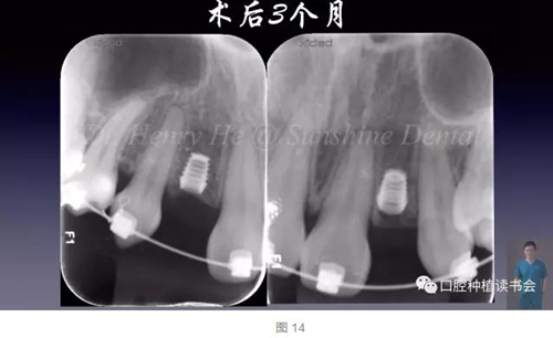 2017口腔醫(yī)師口腔組織病理之牙齦病 2017口腔醫(yī)師口腔組織病理之牙齦病