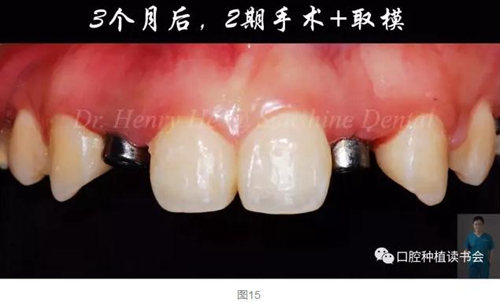 2017口腔醫(yī)師口腔組織病理之牙齦病 2017口腔醫(yī)師口腔組織病理之牙齦病