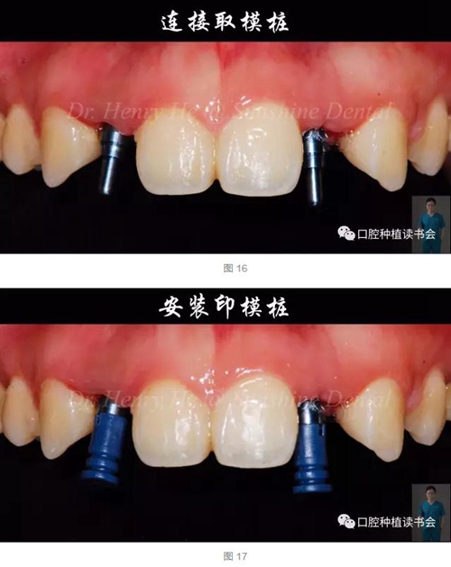 2017口腔醫(yī)師口腔組織病理之牙齦病 2017口腔醫(yī)師口腔組織病理之牙齦病