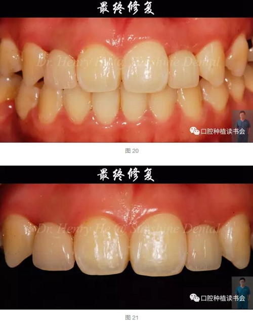 2017口腔醫(yī)師口腔組織病理之牙齦病 2017口腔醫(yī)師口腔組織病理之牙齦病