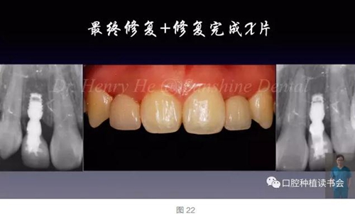 2017口腔醫(yī)師口腔組織病理之牙齦病 2017口腔醫(yī)師口腔組織病理之牙齦病